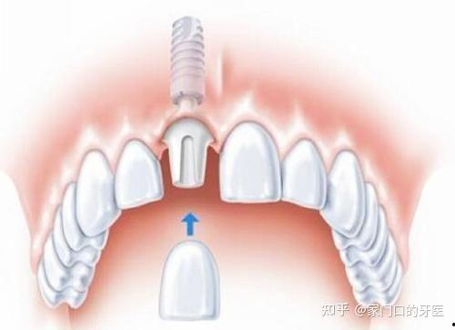 国产种牙失败案例视频讲解,揭秘种植牙风险与选择要点  第3张